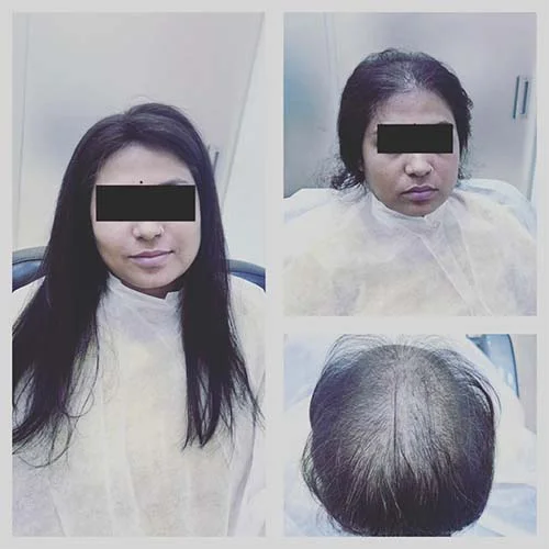 Hair transplantation in Hyderabad