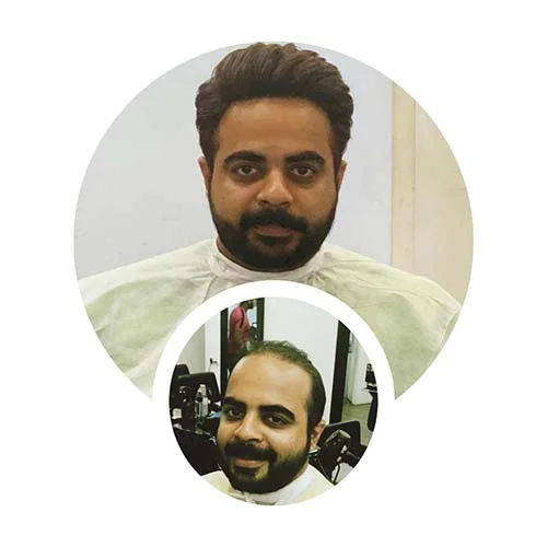 hair replacement in hyderabad